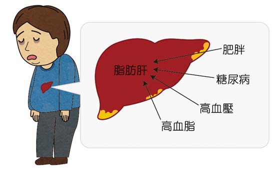 脂肪 肝 症状