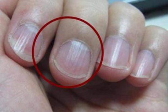 <b>【指甲上有竖纹是怎么回事】---指甲上有竖纹是什么原因</b>